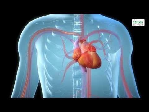 Angioplasty Procedure Animation Video.