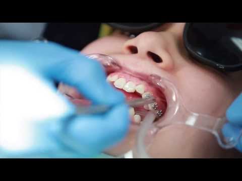 Braces: Putting Braces On Bonding Procedure - Aura Orthodontics