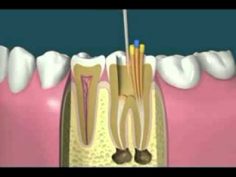 Root Canal Treatment- happy dental care.flv