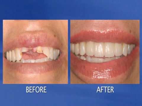 Cosmetic Dentist Los Angeles- Dental Implants, Sedation Dentistry, Veneers, Crowns, Invisalign.