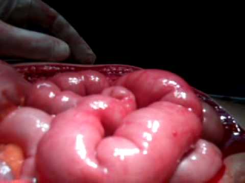 Intestinal Peristalsis (Intraoperative)