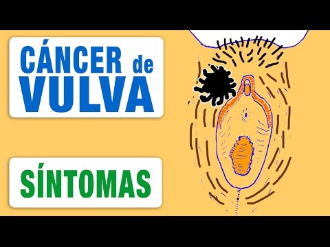 Síntomas del Cancer de Vulva - Cómo Descubrirlo