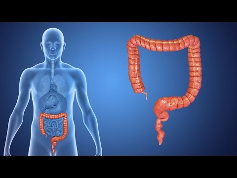 What is Colorectal Cancer?