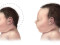Microcephaly Comparison by CDC, via Wikimedia Commons https://en.wikipedia.org/wiki/Microcephaly
