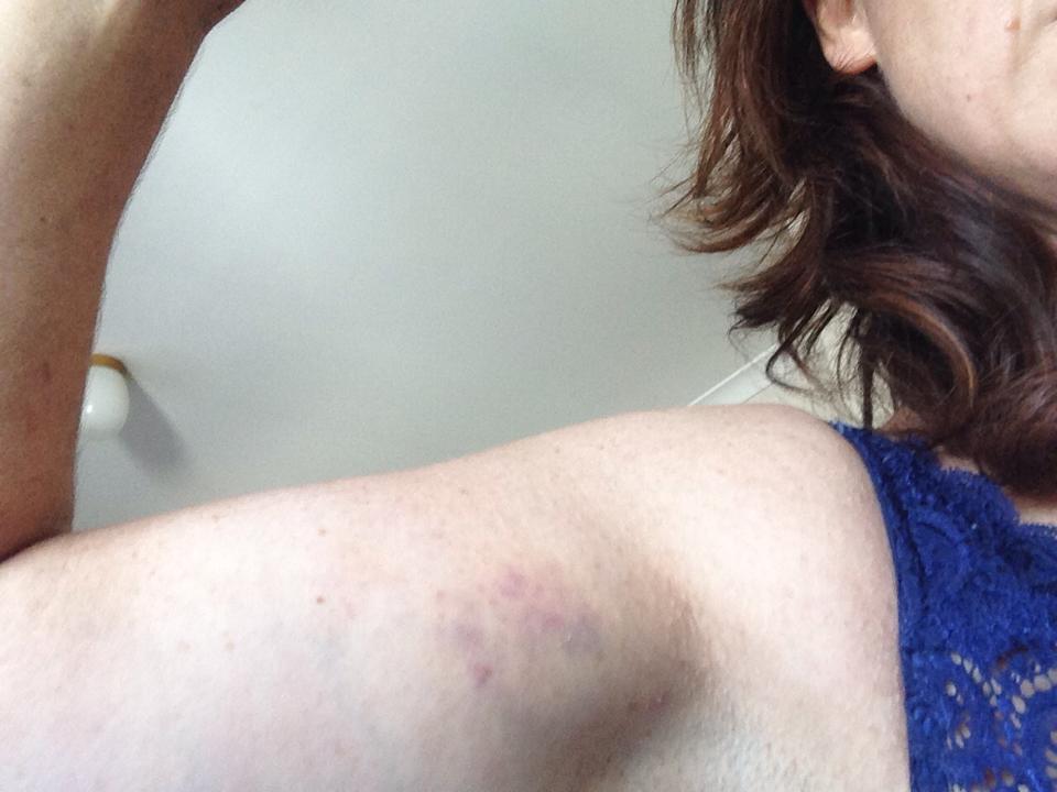 Melbourne Activist Sam Castro sustained injuries protesting Victoria's "Anti-Protest Laws".