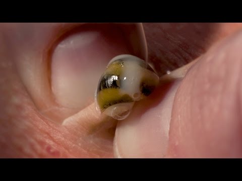 Boy Returns from the Beach with a Snail INSIDE HIS KNEE