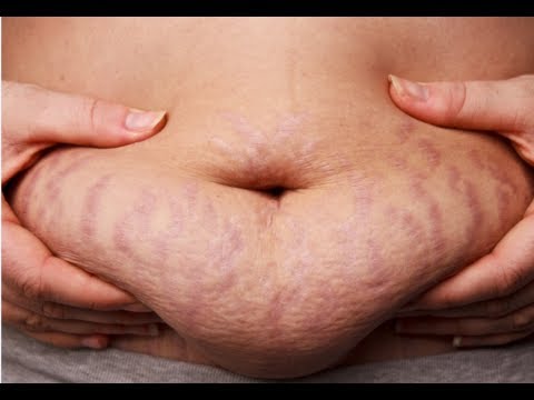 How to Get Rid of Stretch Marks Fast