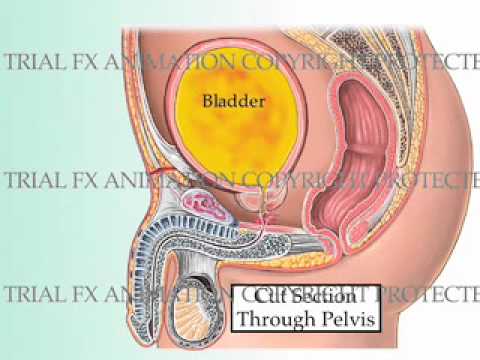 Urinary Bladder Injury Animation