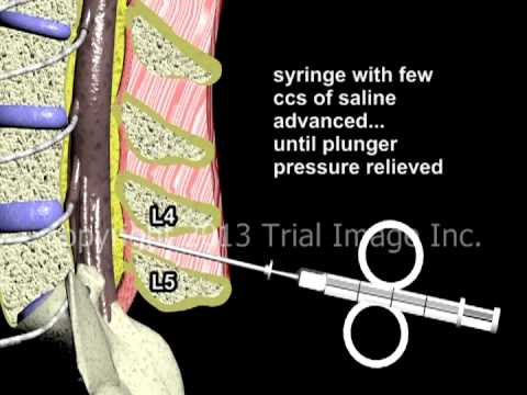 Epidural Spinal Anesthesia - Animation by Cal Shipley, M.D.