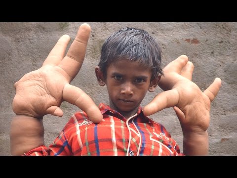 Mystery Condition Gives Indian Boy Gigantic Hands