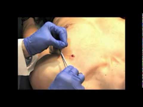 How to Perform a Punch Biopsy of the Skin