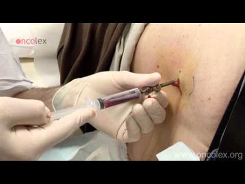 Bone marrow aspiration and biopsy from the iliac crest • Oncolex