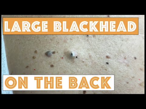 Extracting Big Blackheads on the Back:  A popaholic couple married over 50 years!