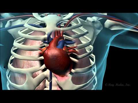 Coronary Heart Disease Animation