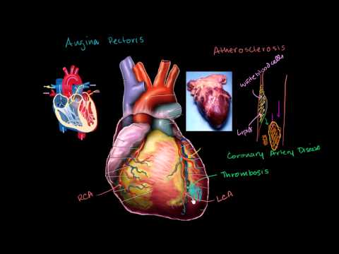 Heart Disease and Heart Attacks