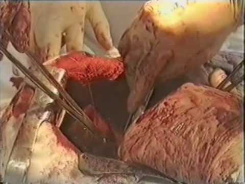 lung cancer surgery