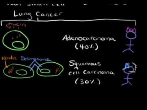 Lung cancer types