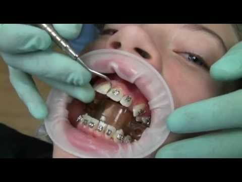 Watch how we put your braces on!