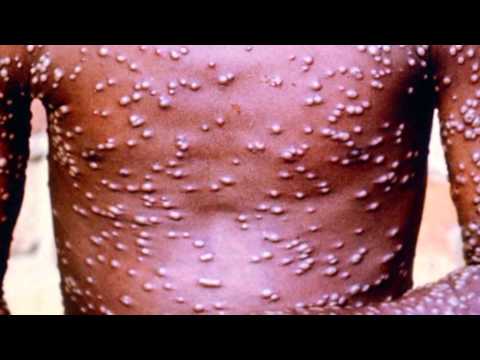 What is smallpox?