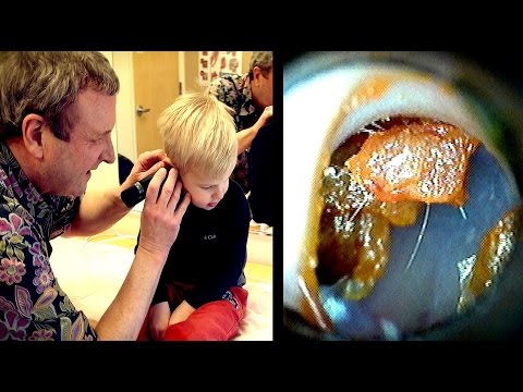 INSIDE AN EAR FULL OF WAX | Dr. Paul