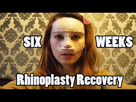 6 Weeks of Rhinoplasty Recovery Vlog Pt. 2