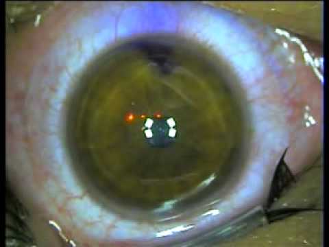 Operacion miopia Laser Excimer LASIK