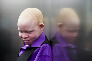 Emmanuel Rutema, 13, of Tanzania, rides an elevator before his surgery at the Shriners Hospital for Children in Philadelphia on Tuesday, June 30, 2015.