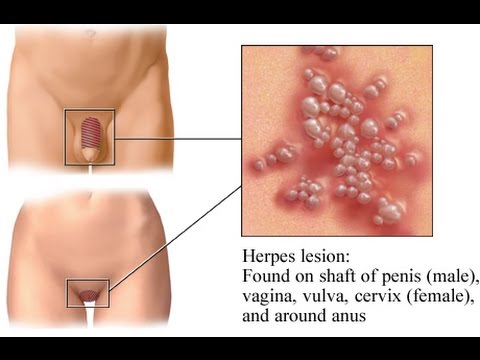 Herpes Simplex