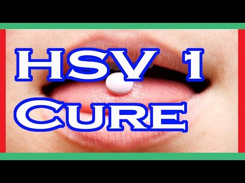 HSV 1 Cure : Herpes Simplex Virus 1 Cure