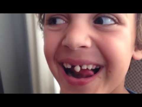 Loose Tooth Pulling Fail