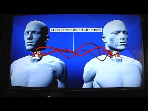 World's First Head Transplant: What's Involved?