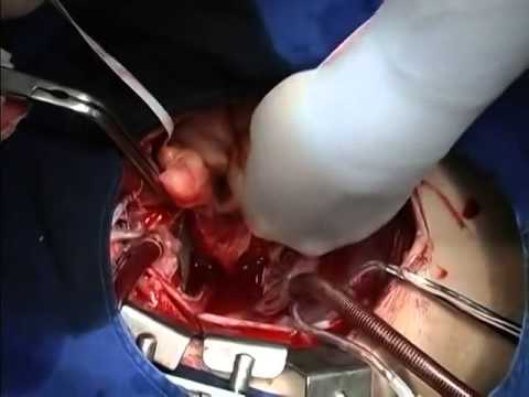 Complete cardiac transplant