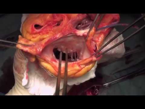 Heart Transplant - Dr. Terry Yau