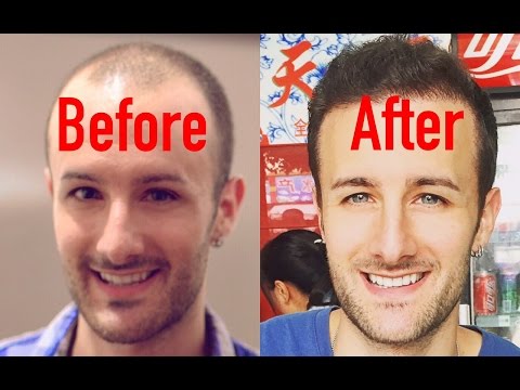 ENTIRE Hair Transplant Surgery Video - Beginning to End