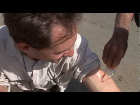 Stung by a Box Jellyfish