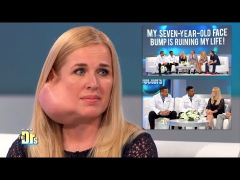 Large Facial Tumor Removal, Parotid Gland: The Doctors TV Show