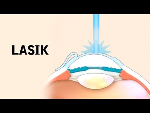 LASIK Surgery and its Risks