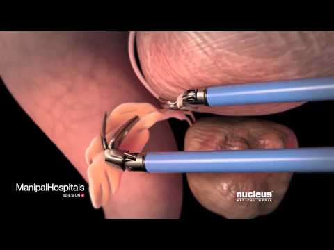 Robotic Prostatectomy | Prostate Cancer | Oncologist | Manipal Hospitals