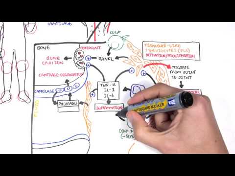 Rheumatoid Arthritis Pathophysiology