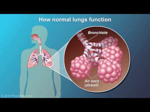 Understanding COPD