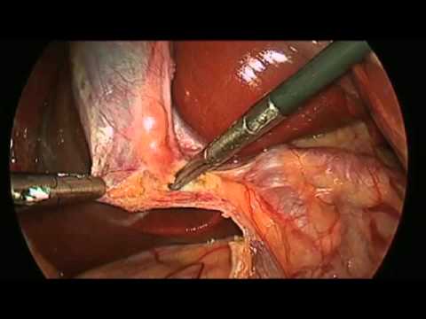 Laparoscopic Cholecystectomy (Gallbladder) Surgery