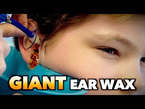 GIANT EAR WAX REMOVAL! | Dr. Paul