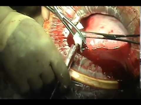 Cesarean Delivery