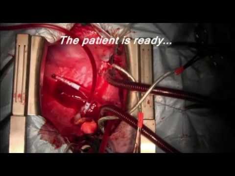 Heart transplantation