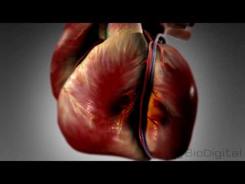 3D Medical Animation - What is a Heart Attack?