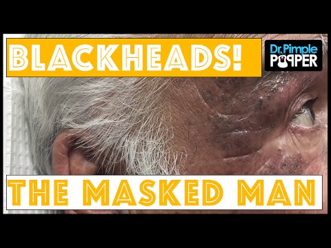 The Masked Man, Extensive Solar Comedones:  Session Two, Part 1 of 2