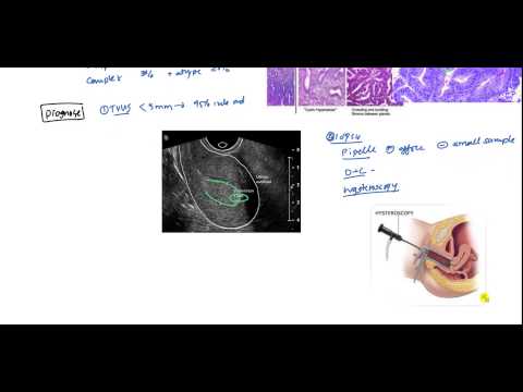 Endometrial Cancer and Hyperplasia for USMLE