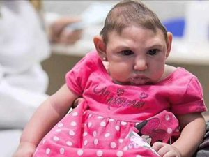 Baby with Zika-related microcephaly born at New Jersey hospital