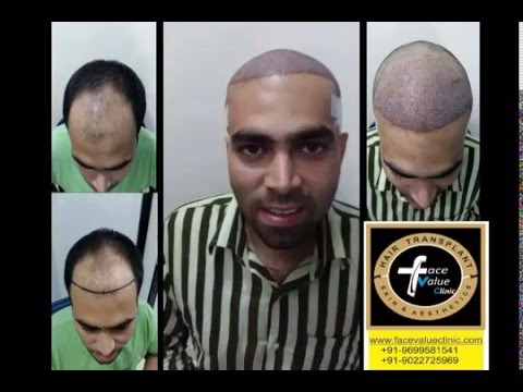 face value hair transplant FUE/cheap & best