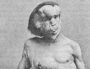 A photograph of Joseph Merrick (1862–1890), sometimes called the "Elephant Man" taken in1889.